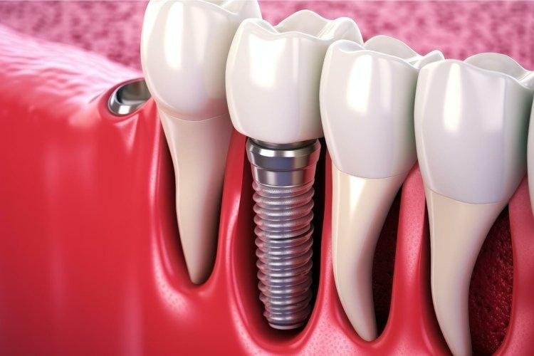 Restore Missing Teeth with Confidence